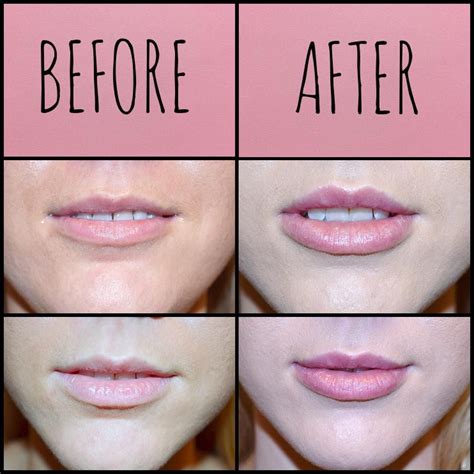 lip fillers near me ava